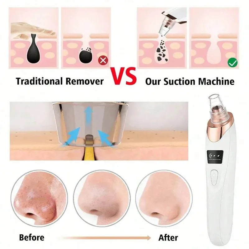 Electric Blackhead Remover Vacuum – Rechargeable Pore Cleaner with 5 Suction Levels for Deep Facial Cleansing